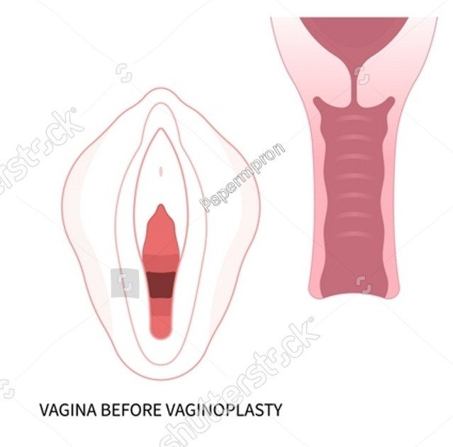 stock-vector-surgery-female-women-vagina-reconstruction-of-minor-vulval-labia-loose-lips-genital-beauty-tighten-2220634197
